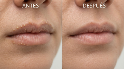 Mi Piel RCS — Crema Correctora Puntos de Fordyce